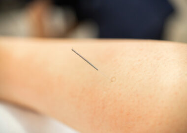 Close-up of a needle doing a dry needling in a physiotherapy center.